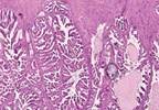 Managing side effects of tamoxifen Managing side effects of tamoxifen