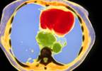 Using a palliative approach to maintain nutrition and reduce discomfort in patients with EC Using a palliative approach to maintain nutrition and reduce discomfort in patients with EC
