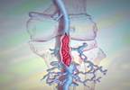 Using anticoagulants to treat chemotherapy-related VTE Using anticoagulants to treat chemotherapy-related VTE