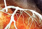 Radiosensitivity: A new focus on cardiovascular sequelae Radiosensitivity: A new focus on cardiovascular sequelae