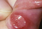 Validive may be effective for prevention of severe oral mucositis Validive may be effective for prevention of severe oral mucositis