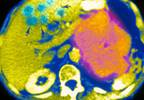 "Inoperable" pancreatic cancer may be treatable after all "Inoperable" pancreatic cancer may be treatable after all