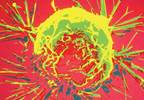 Lisinopril and breast cancer recurrence Lisinopril and breast cancer recurrence