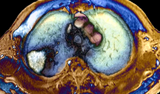 Bisphosphonates may reduce risk of certain breast, colon, and lung cancers Bisphosphonates may reduce risk of certain breast, colon, and lung cancers