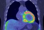 HF/CM risks in breast chemotherapy HF/CM risks in breast chemotherapy