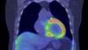 HF/CM risks in breast chemotherapy HF/CM risks in breast chemotherapy