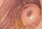 The role of sunitinib in the treatment of GIST The role of sunitinib in the treatment of GIST