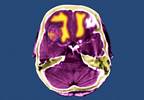 A clearer role for radiotherapy in high-risk melanoma A clearer role for radiotherapy in high-risk melanoma