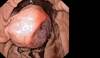 Oral therapy: Managing side effects can aid adherence Oral therapy: Managing side effects can aid adherence