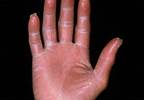 Corticosteroids for infusion reactions Corticosteroids for infusion reactions