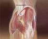 Large-volume IM injections:
A review of best practices Large-volume IM injections:
A review of best practices