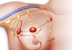 Hodgkin lymphoma treatment risk of premature menopause determined Hodgkin lymphoma treatment risk of premature menopause determined