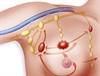 Fear of lymphedema after sentinel lymph node biopsy greater than risk Fear of lymphedema after sentinel lymph node biopsy greater than risk