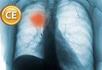 Non-small cell lung cancer: Molecular targets and
emerging options for care Non-small cell lung cancer: Molecular targets and
emerging options for care