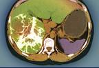 Can radiation therapy help resolve the liver cancer 'paradox'? Can radiation therapy help resolve the liver cancer 'paradox'?