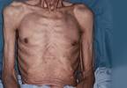 Cancer Cachexia Associated With Poor Outcomes Cancer Cachexia Associated With Poor Outcomes