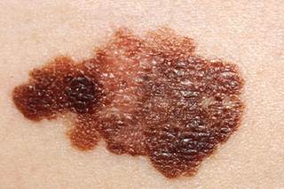 Radiotherapeutic Bandage Shows Potential as Treatment for Skin Cancer Radiotherapeutic Bandage Shows Potential as Treatment for Skin Cancer