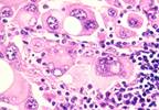 Kinase Inhibitors: Managing Adverse Effects in the Treatment of Metastatic Melanoma Kinase Inhibitors: Managing Adverse Effects in the Treatment of Metastatic Melanoma