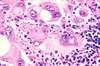 Kinase Inhibitors: Managing Adverse Effects in the Treatment of Metastatic Melanoma Kinase Inhibitors: Managing Adverse Effects in the Treatment of Metastatic Melanoma