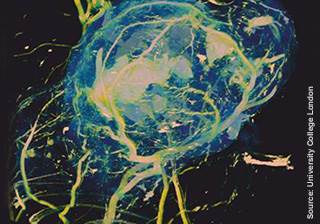 Tumor consumption of sugar on MRI could be a breakthrough in diagnostic imaging Tumor consumption of sugar on MRI could be a breakthrough in diagnostic imaging