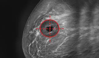 Cologuard for colorectal cancer screening now available Cologuard for colorectal cancer screening now available