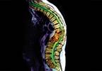 Using palliative radiotherapy to relieve bone metastasis pain Using palliative radiotherapy to relieve bone metastasis pain