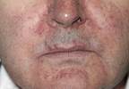 Managing skin effects of EGFR inhibitor therapy Managing skin effects of EGFR inhibitor therapy