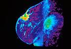 Low recurrence breast cancer rates with negative margins Low recurrence breast cancer rates with negative margins