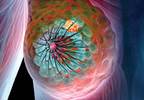 Diagnostic Assay Improves Outcomes Prediction in Early Breast Cancer, Nixing Need for Chemo Diagnostic Assay Improves Outcomes Prediction in Early Breast Cancer, Nixing Need for Chemo
