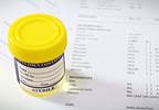 Urinalysis in patients receiving alkylating agents Urinalysis in patients receiving alkylating agents