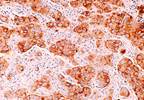 Luminal breast tumors have enhanced response to antiestrogen therapy Luminal breast tumors have enhanced response to antiestrogen therapy