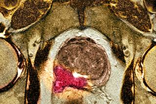 Nomogram determines individualized estimates of screen-detected prostate cancer overdiagnosis Nomogram determines individualized estimates of screen-detected prostate cancer overdiagnosis