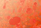 Anemia in patients with MDS Anemia in patients with MDS