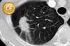 Lung cancer: Guidelines, new drugs improve outcomes Lung cancer: Guidelines, new drugs improve outcomes