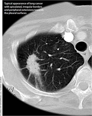 Typical appearance of lung cancer with spiculated, irregular borders Typical appearance of lung cancer with spiculated, irregular borders