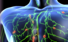 Infection may cause breast implant-associated anaplastic large cell lymphoma Infection may cause breast implant-associated anaplastic large cell lymphoma