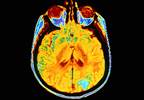 Nivolumab Demonstrates Consistent Adverse Event Profile for Recurrent Glioblastoma Nivolumab Demonstrates Consistent Adverse Event Profile for Recurrent Glioblastoma