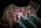 Umbilical cord blood stem cells treat leukemia and lymphoma Umbilical cord blood stem cells treat leukemia and lymphoma