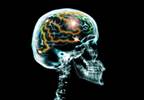Personalized Medicine Approach Not Straightforward in Glioblastoma Personalized Medicine Approach Not Straightforward in Glioblastoma
