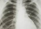 Afatinib active in many TKI-pretreated patients with NSCLC and uncommon EGFR mutations Afatinib active in many TKI-pretreated patients with NSCLC and uncommon EGFR mutations