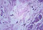 ESR1 Mutations Prevalent in ER+ Metastatic Breast Cancer ESR1 Mutations Prevalent in ER+ Metastatic Breast Cancer