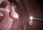 Risk for Disease, Advanced Stage at Diagnosis Higher With Delayed Colonoscopy After Positive FIT Results Risk for Disease, Advanced Stage at Diagnosis Higher With Delayed Colonoscopy After Positive FIT Results