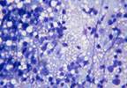 QoL, Pain from Bone Metastases May Improve as Early as 10 Days After RT QoL, Pain from Bone Metastases May Improve as Early as 10 Days After RT