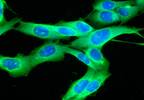 Nivolumab Yields Better Clinical Outcomes for Advanced Melanoma Nivolumab Yields Better Clinical Outcomes for Advanced Melanoma