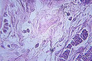 Scientists bring personalized medicine for breast cancer one step closer Scientists bring personalized medicine for breast cancer one step closer
