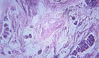 Diabetes and its treatment impact prognosis in patients with breast cancer Diabetes and its treatment impact prognosis in patients with breast cancer