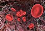 Clinical Benefit of Simtuzumab Inconsistent for Myelofibrosis Clinical Benefit of Simtuzumab Inconsistent for Myelofibrosis