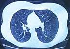 CTCs Promising as Biomarker to Identify Lung Cancer Recurrence CTCs Promising as Biomarker to Identify Lung Cancer Recurrence
