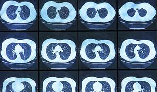 Incidence of lung cancer in the U.S. declining Incidence of lung cancer in the U.S. declining