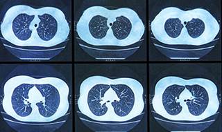 IMPRESS study shows continuing tyrosine kinase inhibitors after progression not effective IMPRESS study shows continuing tyrosine kinase inhibitors after progression not effective